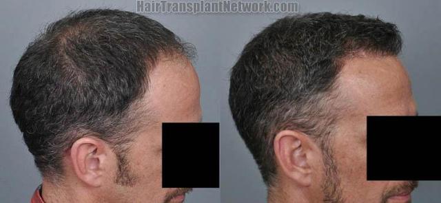 Before and after surgical hair restoration images