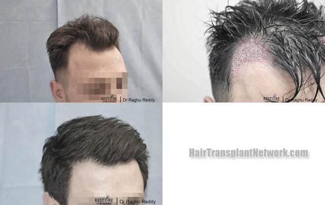 Hair transplantation surgery before and after pictures