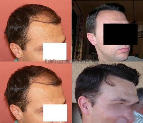 Hair transplantation surgery before and after photos