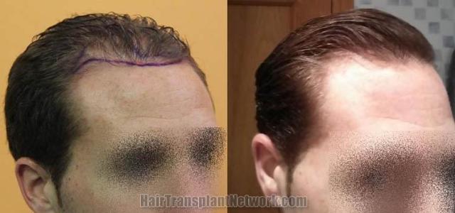 Hair transplantation surgery before and after images