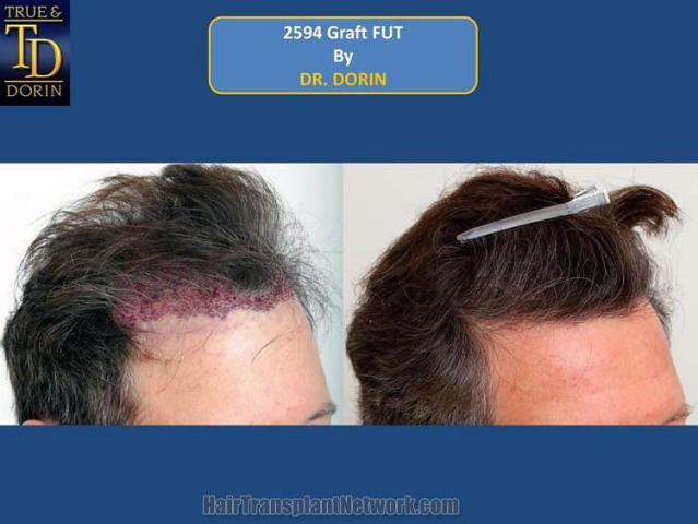 Hair transplant surgery before and after photos