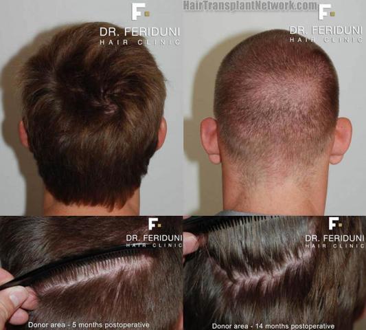 Hair transplantation surgery before and after pictures