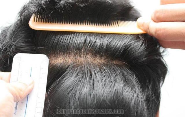 Hair restoration procedure before and after pictures