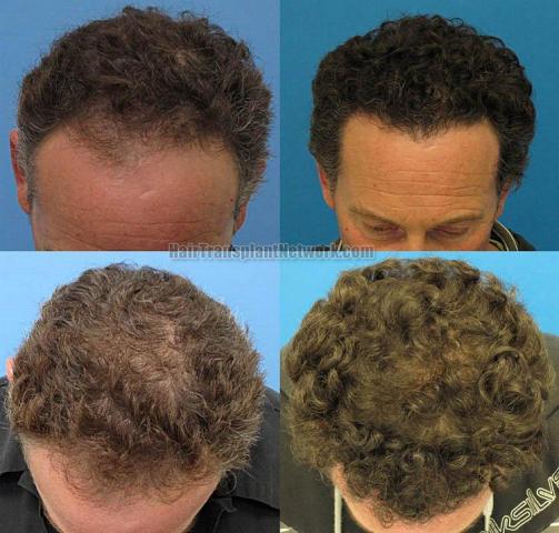 Top view photos before and after hair restoration