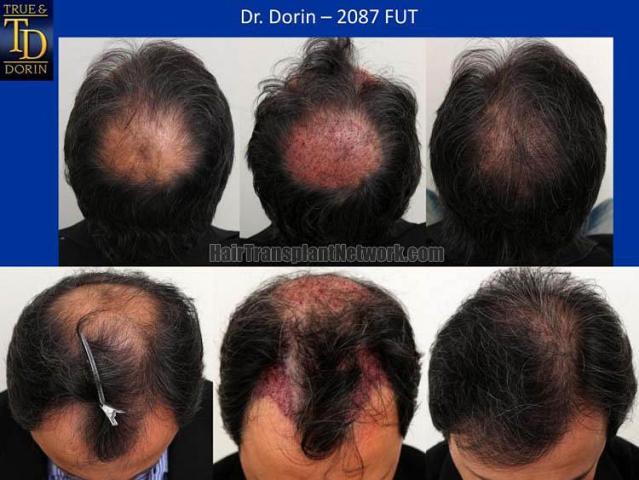 Hair transplantation surgery before and after photos