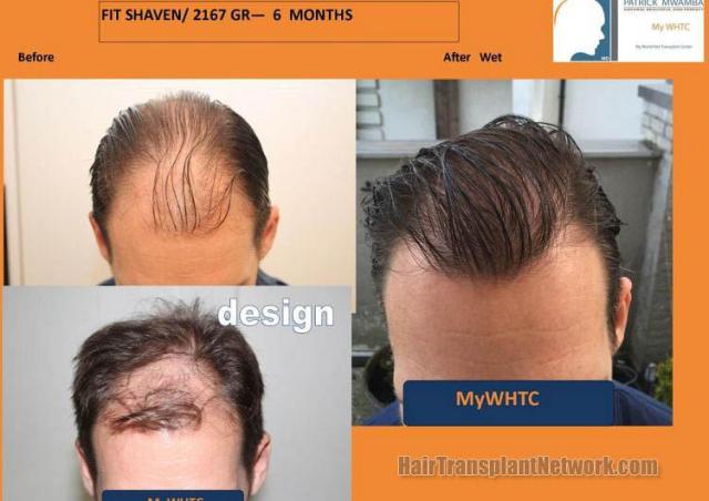 Hair transplantation surgery before and after photos