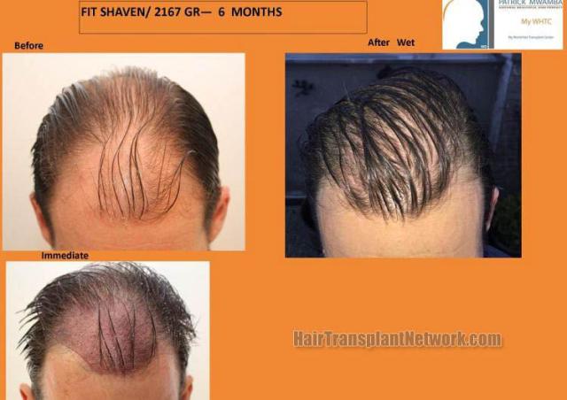 Hair restoration surgery before and after photos