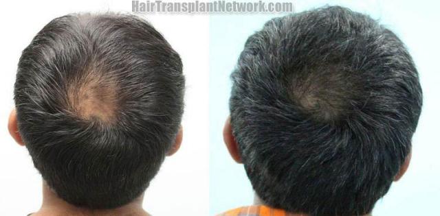 Hair restoration procedure before and after pictures