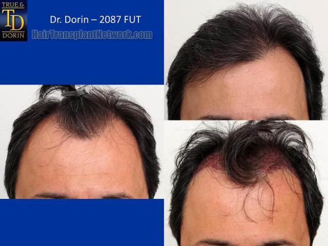 Hair restoration procedure before and after results