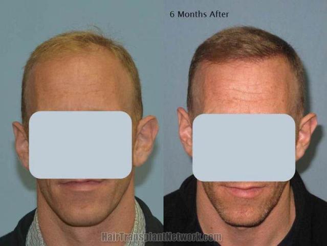 Hair restoration procedure before and after results