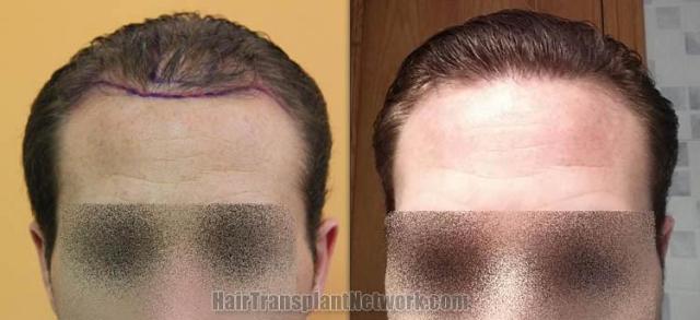 Hair restoration procedure before and after results