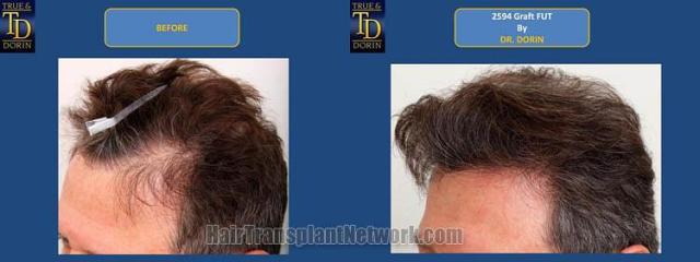 Hair transplantation surgery before and after pictures