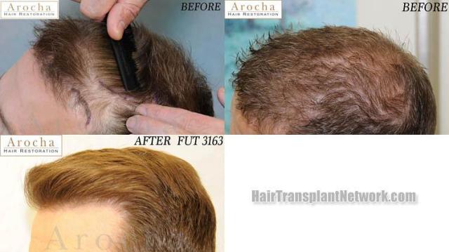 Hair transplantation surgery before and after pictures