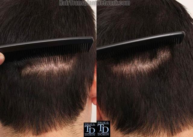 Hair restoration surgery before and after photos