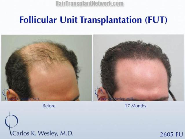 Hair transplantation surgery before and after photos