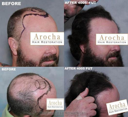 Hair transplantation surgery before and after images