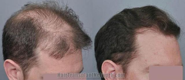 Hair transplantation surgery before and after pictures