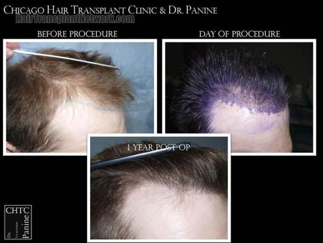 Hair transplantation surgery before and after photos