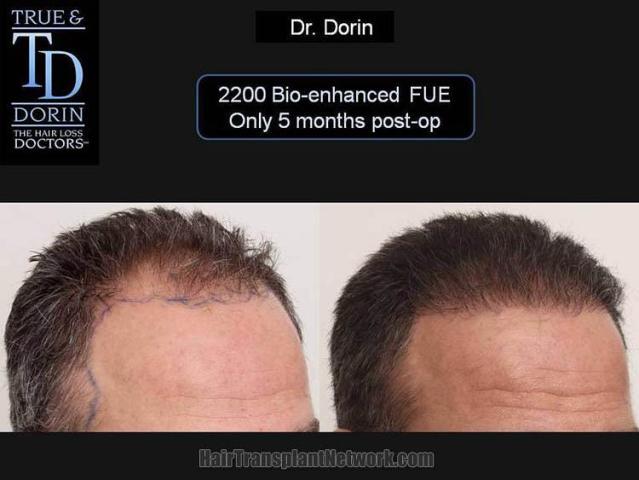 Hair transplantation surgery before and after images