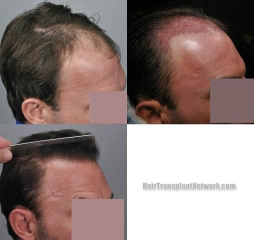 Hair restoration procedure before and after pictures