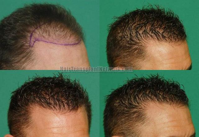 Hair restoration procedure before and after pictures