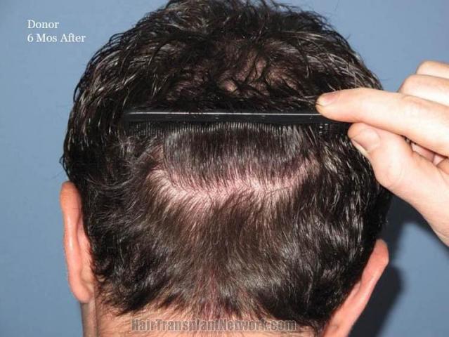 Surgical hair transplantation result photographs