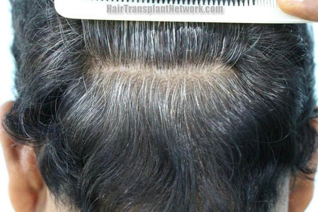 Hair transplantation surgery before and after images