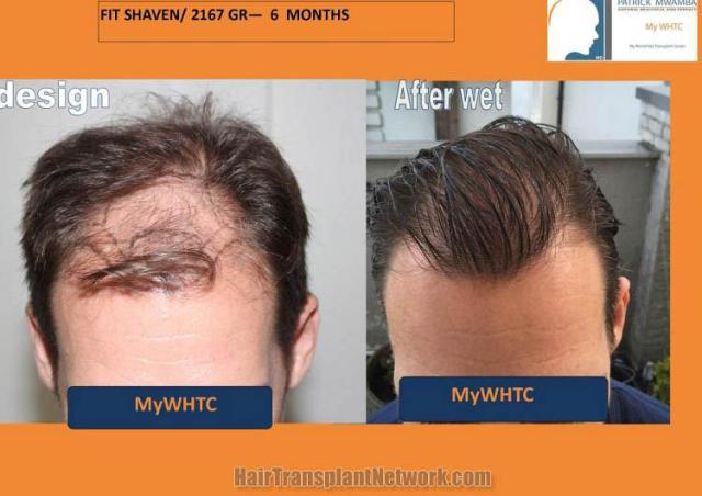 Hair restoration surgery before and after images