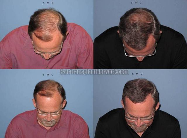 Hair restoration procedure before and after pictures