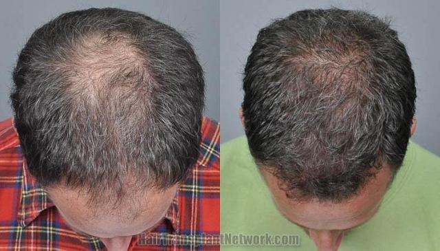 Hair replacement surgery before and after images