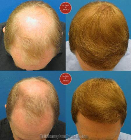 Top view before and after hair restoration results