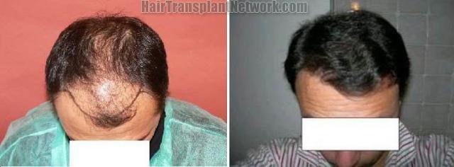 Hair restoration procedure before and after results