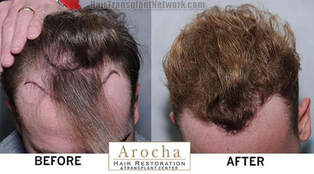 Hair replacement surgery before and after images