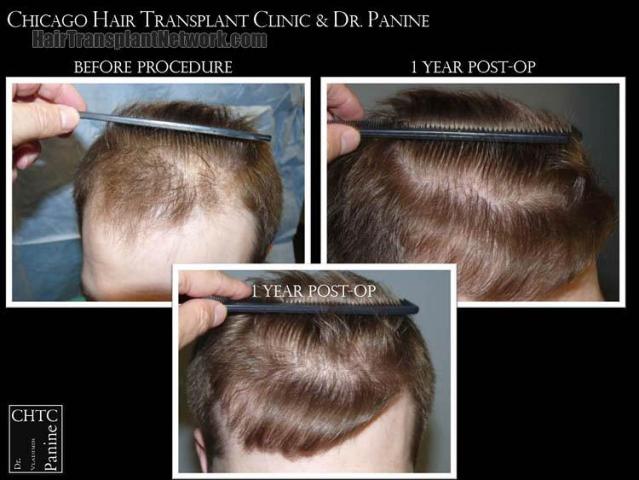 Hair transplantation surgery before and after photos