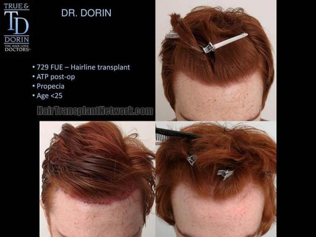 Hair transplantation surgery before and after photos