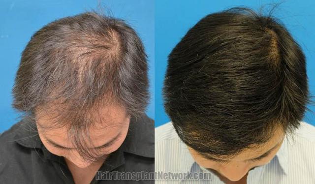 Hair restoration procedure before and after results