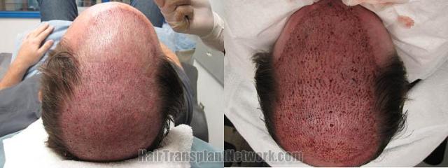 Hair restoration procedure before and after result images