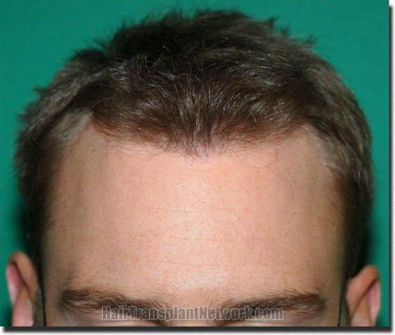 Hair restoration procedure results