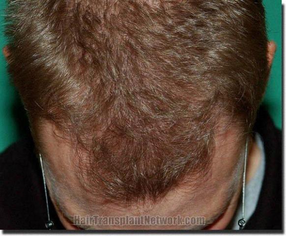 Hair restoration procedure results