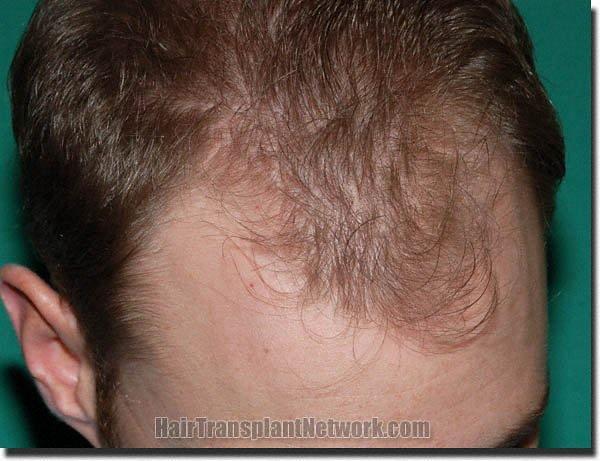 Hair restoration procedure results