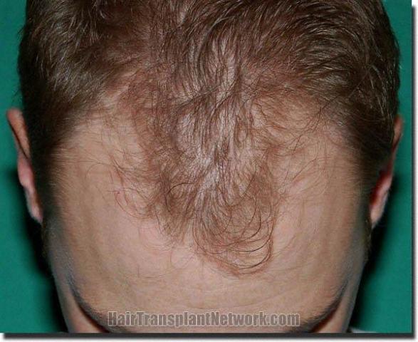 Hair restoration procedure results