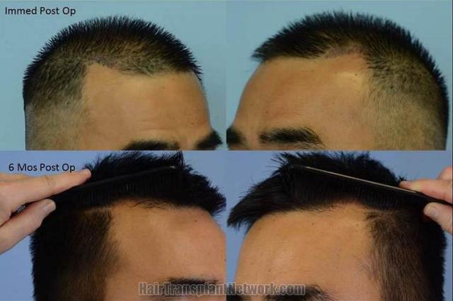 Hair transplantation surgery before and after images