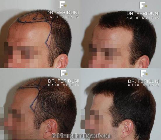 Before and after surgical hair restoration images