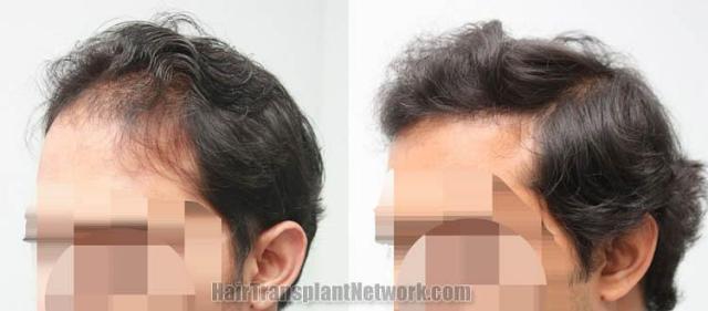 Hair transplantation surgery before and after pictures