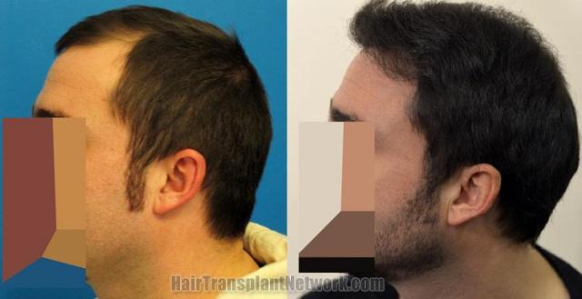 Hair transplantation surgery before and after photos