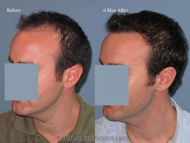 Hair transplantation surgery before and after images