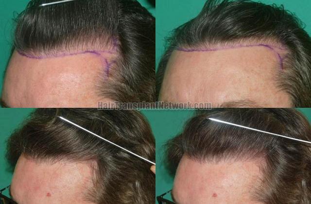 Hair transplantation surgery before and after photos