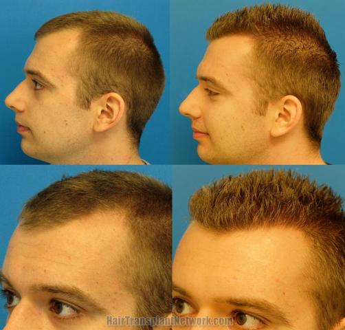 Hair transplantation surgery before and after pictures