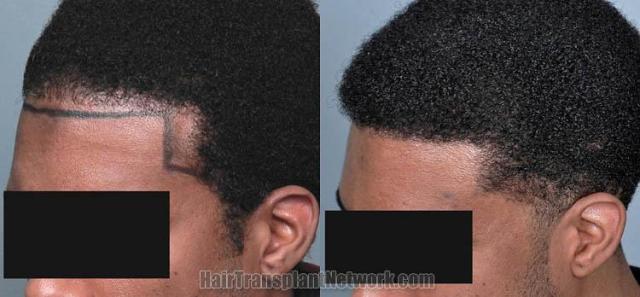 Hair transplantation surgery before and after images