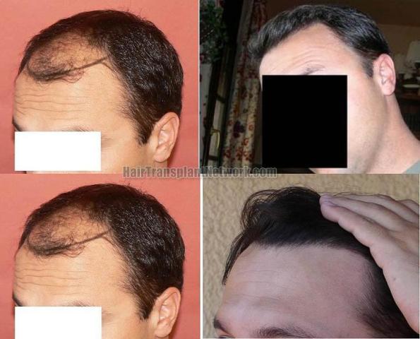 Hair transplantation surgery before and after images